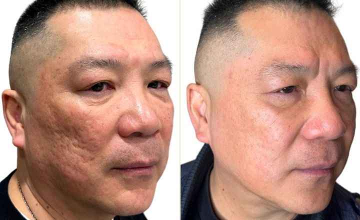 londoners-trust-microneedling-for-skin-reset